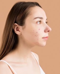 Does Your Diet Really Impact Acne?