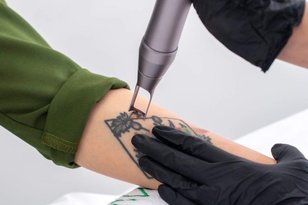 Tattoo removal treatment 
